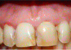 Porcelain crowns to correct decayed teeth