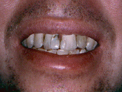 Decayed teeth corrected with porcelain crowns