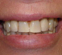 Crowns with a special attachment for a partial denture with no clasps