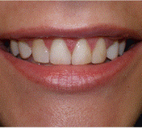 Veneers Correction a gummy smile