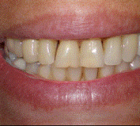 Orthodontic, Implant, Veneer and Crown combination to correct crooked teeth