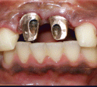 Zirconium Crowns, Veneers and laser gum contouring to correct accident damage and poor implant aesthetics