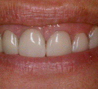 Chipped discolored teeth corrected with veneers